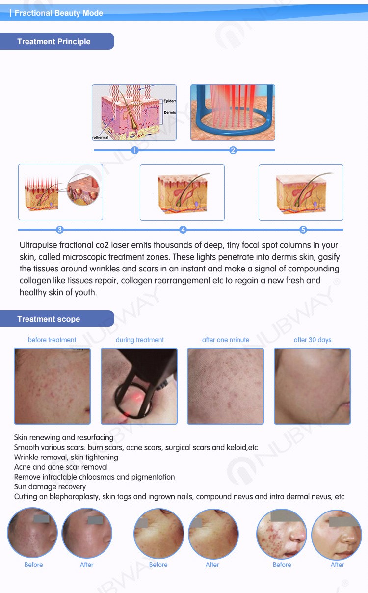 newest style vaginal tighten Fractional Co2 vaginal tightening laser equipment
