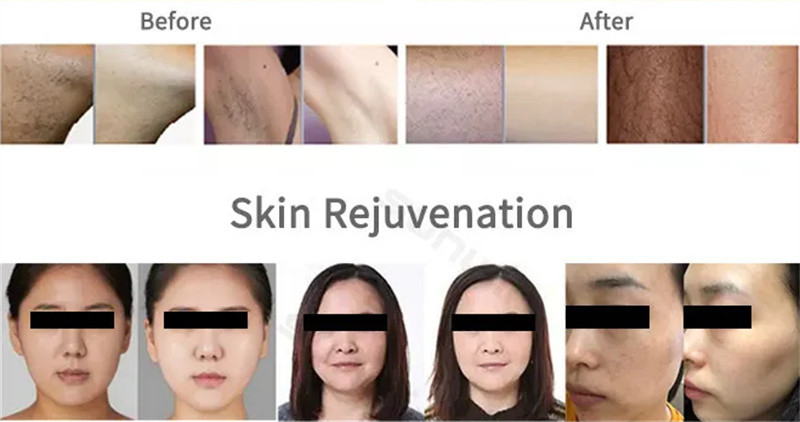 Professional 808nm Diode Laser 2 in 1 Hair Removal Picosecond Laser Tattoo Removal Device