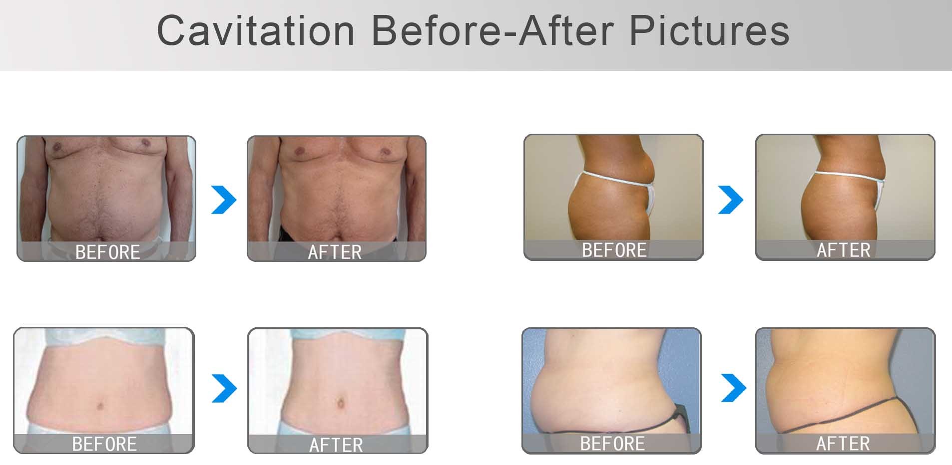 Nubway Trilipo salon use lipolaser cavitation machine ultrasonic slimming machine