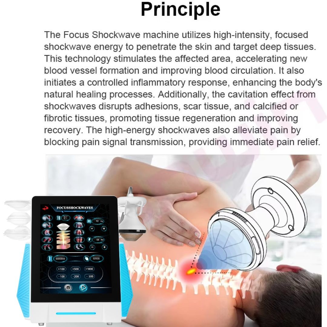 Advanced Focus Shockwave Physical Therapy Equipment for ESWT Treatment of Erectile Dysfunction