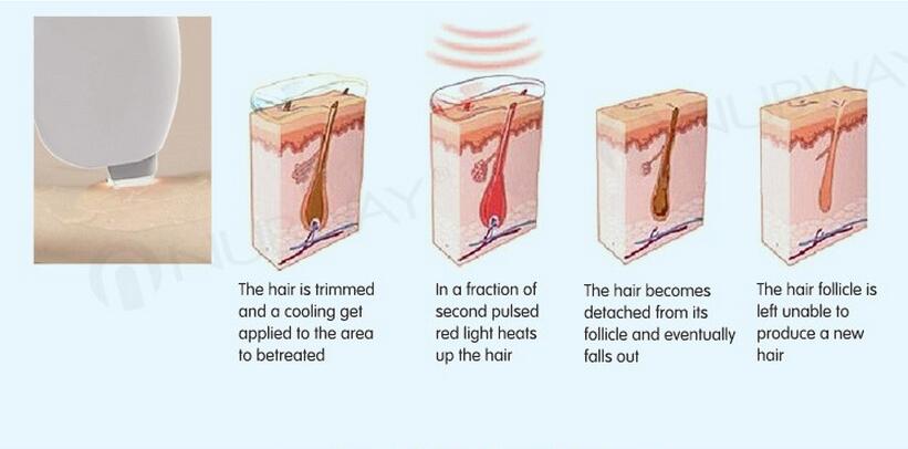 2016 new design 808nm diode laser hair removal machine /hair removal speed 808