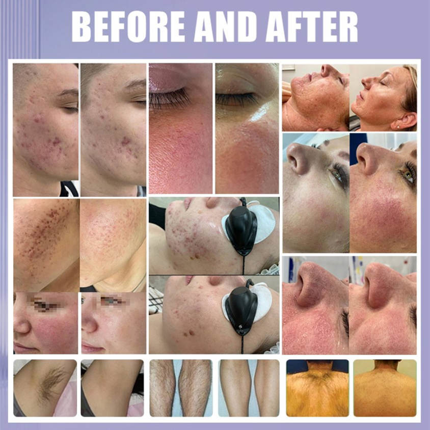 Salon And Clinic IPL Hair Removal Machine