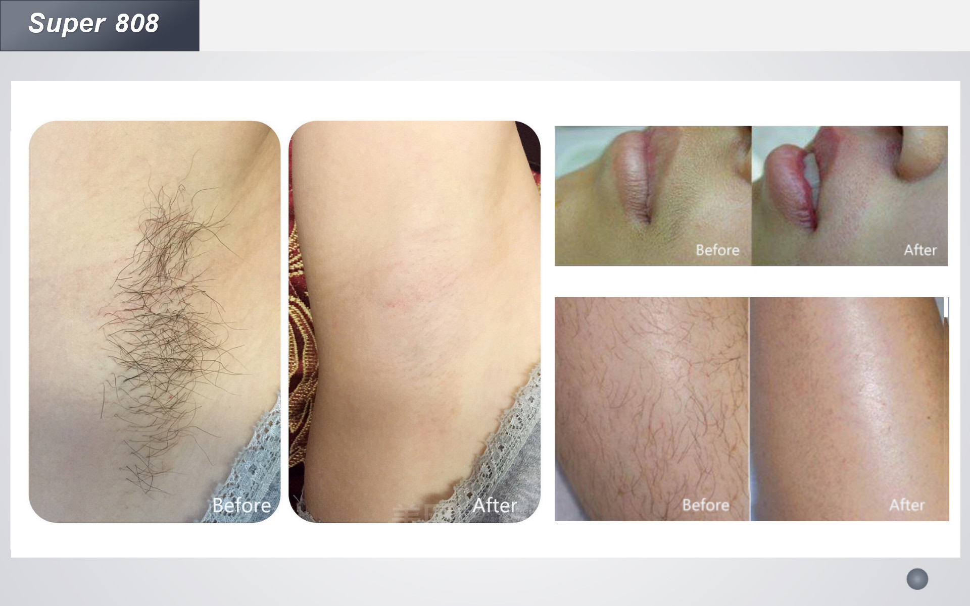 Pain Free 800W Diode Laser Hair Removal Machine 500W