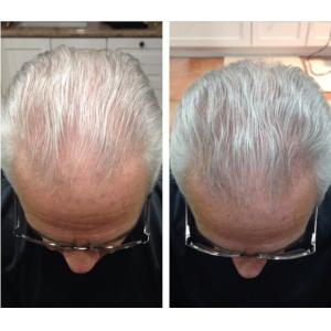 Buy cheap hair oil control laser cap product