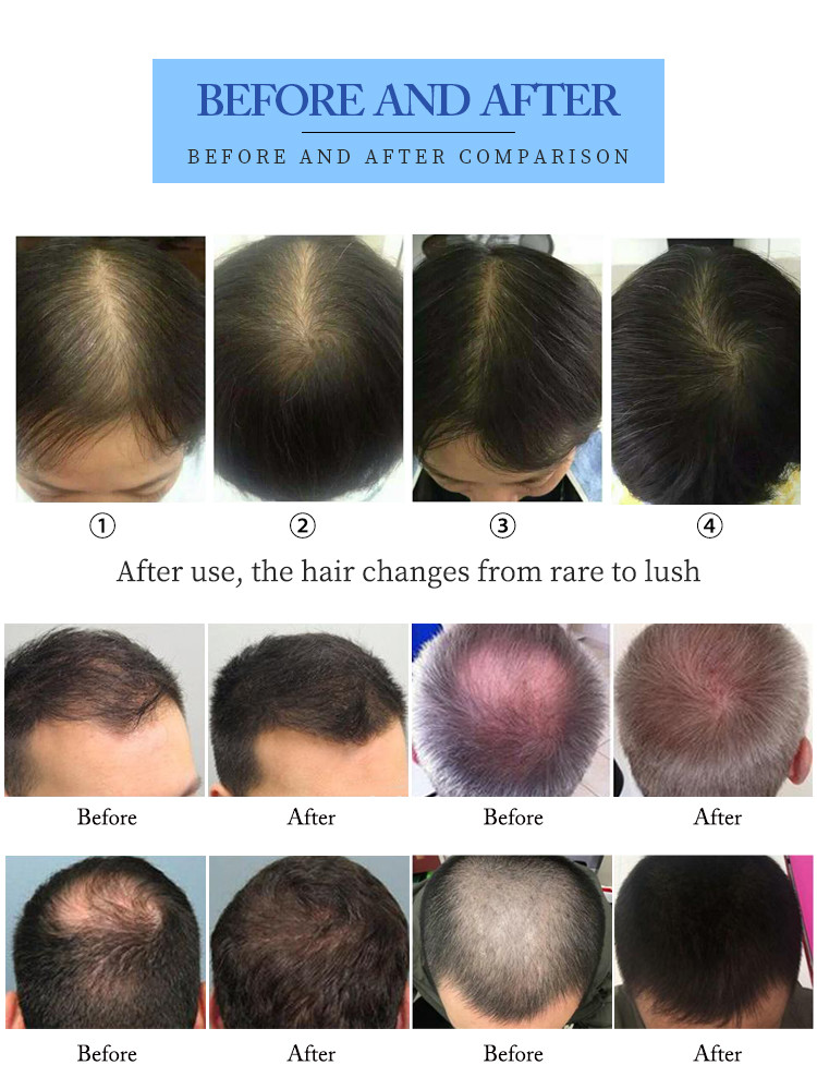 660nm Diode Laser Hair Growth Device For Hair Regeneration / Scalp Nourishment