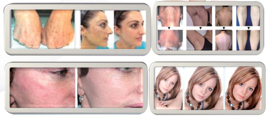 4000w Laser Hair Removal Device / SHR IPL Multifunctional Beauty Machine