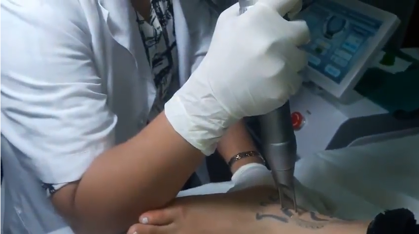 lumenis yag laser switched nd yag laser tattoo removal