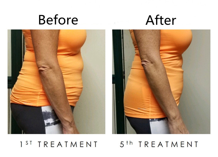 360 Degree Cryolipolysis Coolsculpting Machine Aesthetics Slimming
