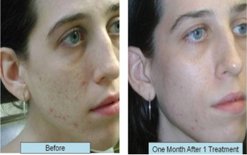 CO2 Laser Fractional Skin Resurfacing Treatment