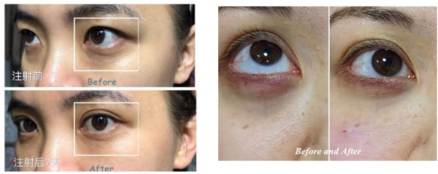 Sodium Hyaluronate Solution For Eyes Remove Dark Circles Dermal Filler 1ml
