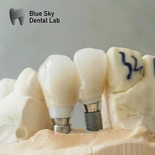 Precision Milled Zirconia Abutment With Single Implant Crown