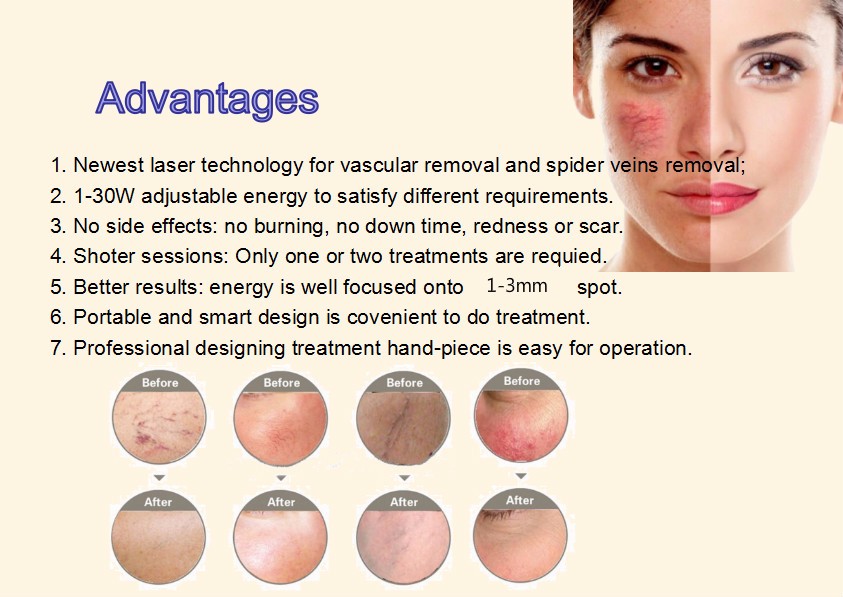 Skin Rejuvenation Spider Vein Treatment Machine , Adjustable Laser Vein Removal Machine