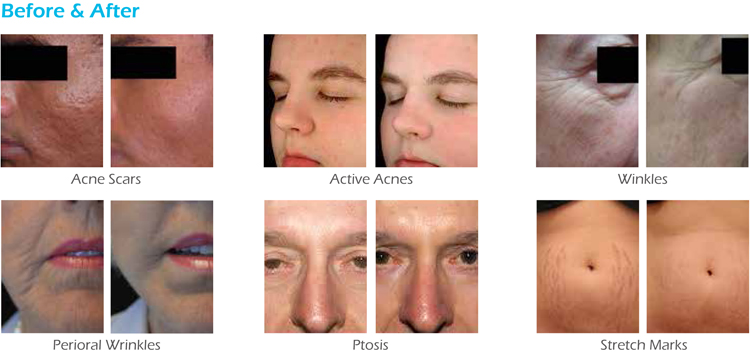 Fractional RF Radio Frequency acne removal face lifting anti aging wrinkle machines