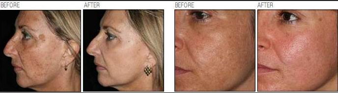 Mole Removal CO2 Fractional Laser Machine , CO2 Laser Machine For Acne Scars