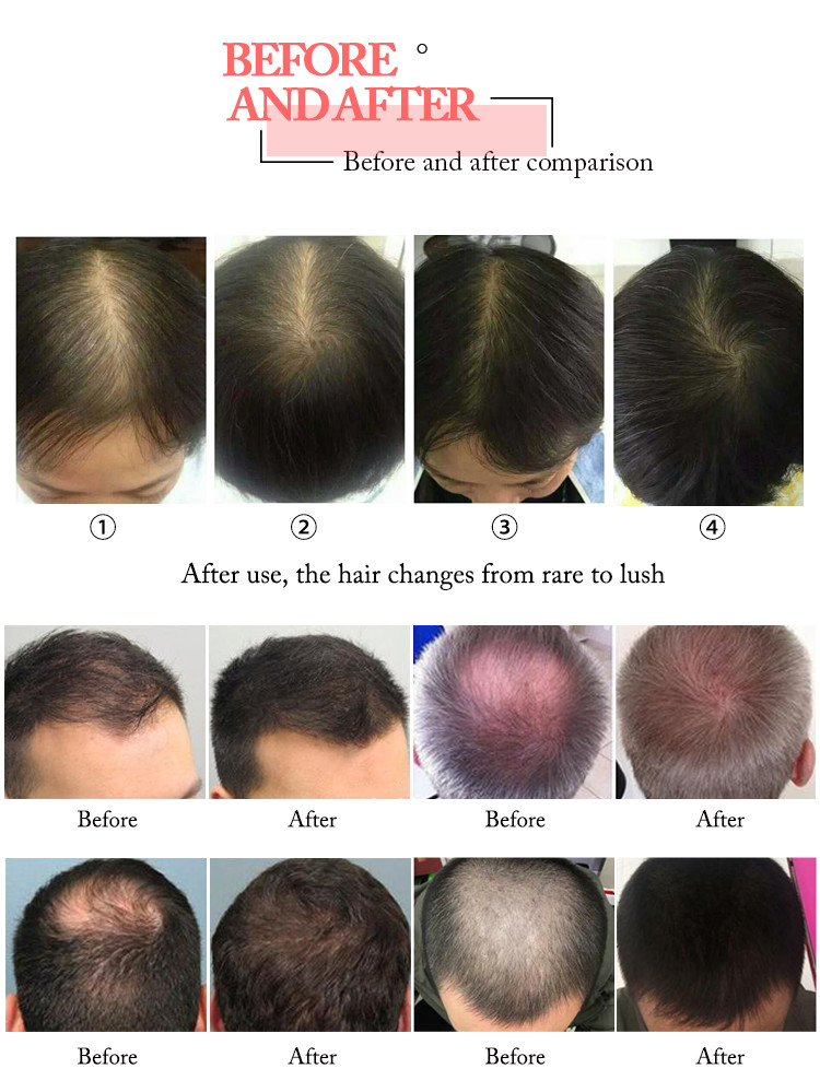660nm Diode Laser Hair Growth Machine , Anti Hair Loss Treatment Machine