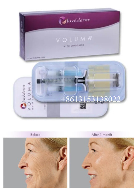 Juvederm Voluma Injectable Dermal Filler HA Gel For Face