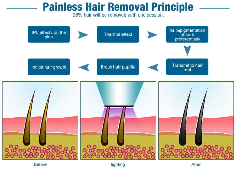 best portable ipl no hair machine / cheap ipl hair removal