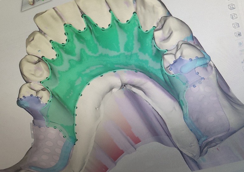 CAD Digital Impression Of Oral Scanning STL Files
