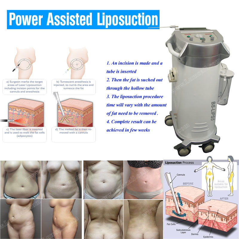 Liposuction Suction Assisted Slimming Beauty Equipment Fat Removal Plastic Material
