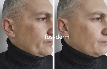 2ml HA Injectable Dermal Filler For Fine Wrinkles