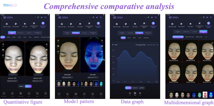 Effective Acne Treatment with Q1 Q2 Skin Analysis Machine and Pigmentation Analysis