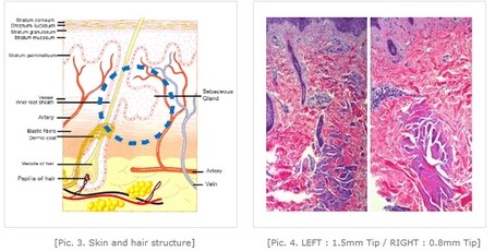 RF Scar removal microneedle rf beauty device For Wrinkle Removal / Skin Tightening