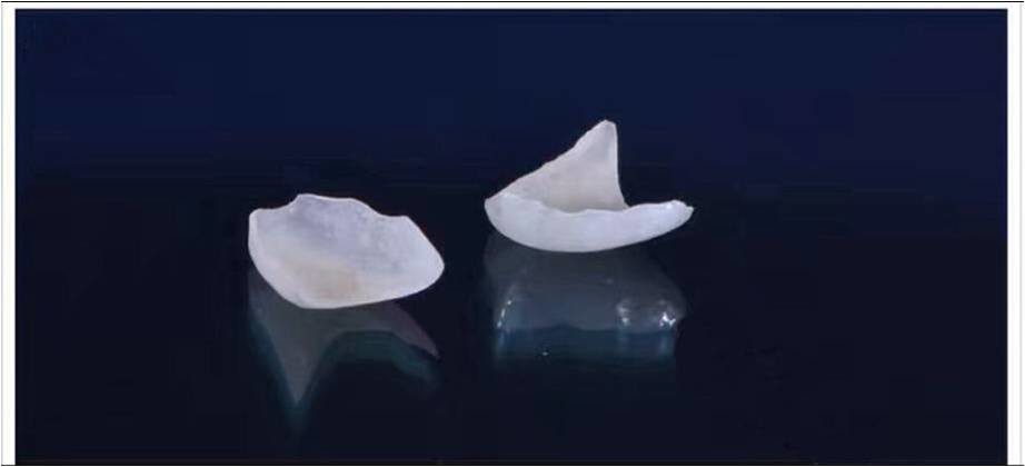 Natural Looking All Porcelain Veneers EMAX Dental Crown