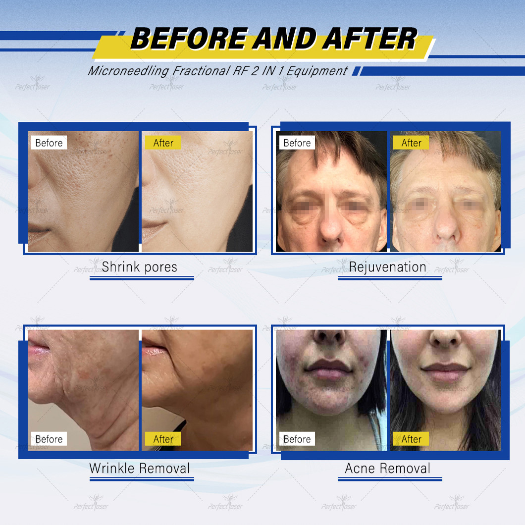 4MHz Radiofrequency Skin Tightening Skin Rejuvenation Machine For Skin Rejuvenation