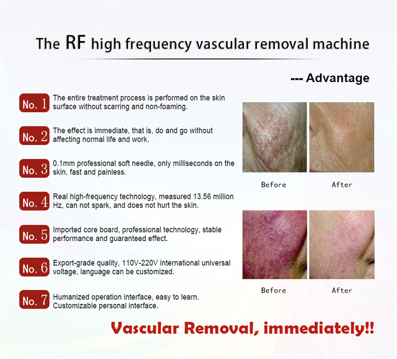 Vascular Spots Varicose Veins Removal Machine RF 980nm Diode Laser