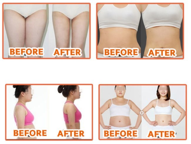 Ampoule Liplysis Solution Injection For Fat Disslove And Weight Loss
