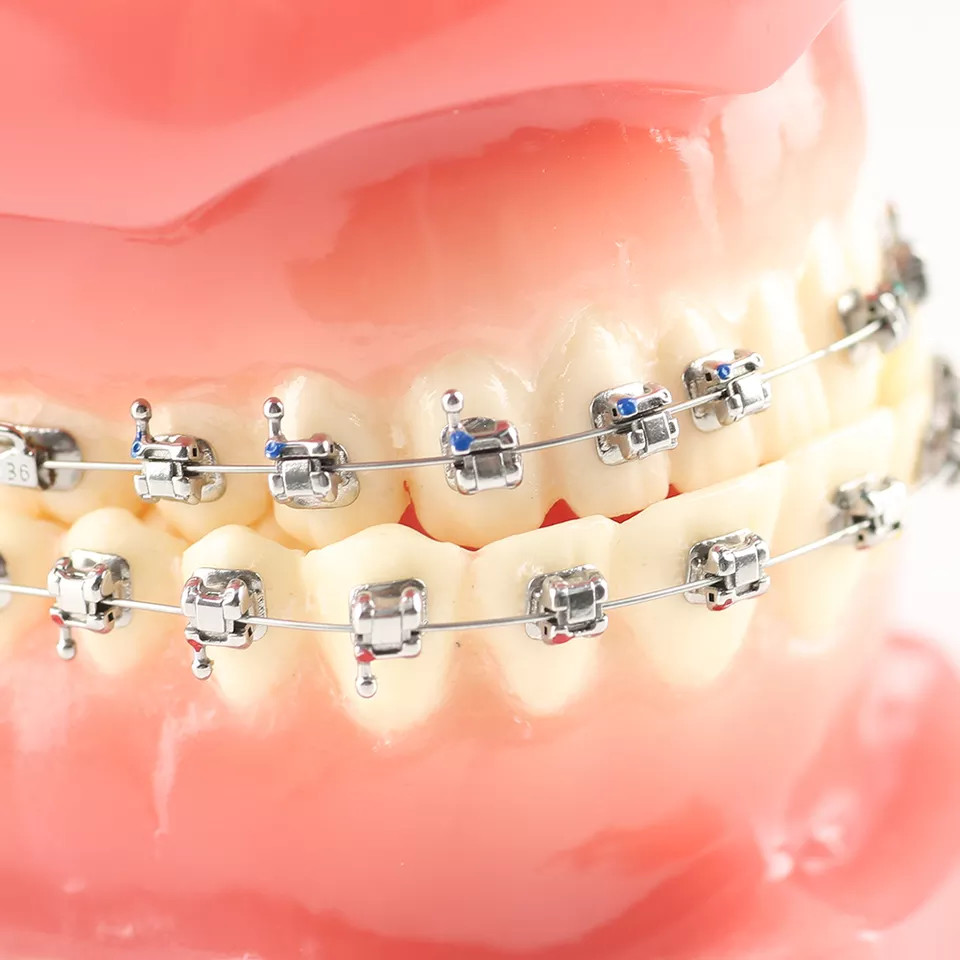 Self Ligating Roth MBT Bracket 0.022 0.018 No Hook 3 WH 345 WH Laser Mark No Laser Mark 20 1 pcs set Orthodontic Dental Braces