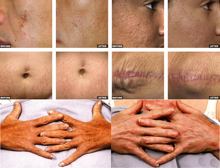 Professional fractional co2 laser Wrinkle Removal medical laser system machines