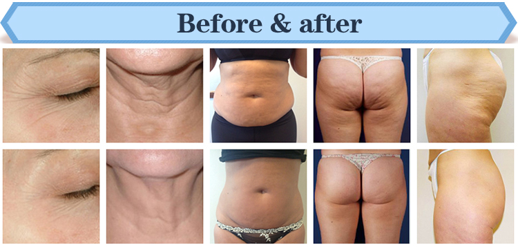 Ultrasonic liposuction ultra cavitation vacuum rf skin tighten body slimming machine