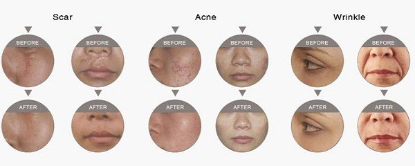 Co2 Fractional Laser RF Wrinkle Removal Machine 30W Safety Skin Laser Machine