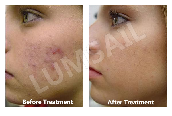 Facial Treatment LED Phototherapy Machine , Acne Light Therapy Devices