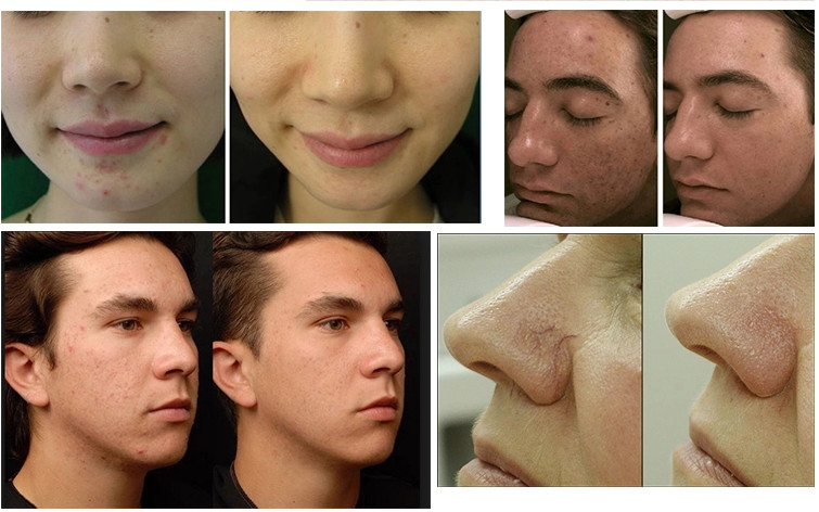 stretch mark removal rf fractional rf microneedle machine