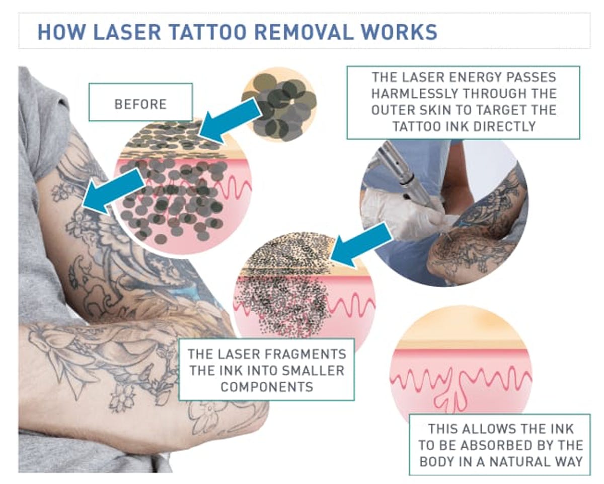 755nm 532nm picolaser Laser Tattoo Removal Machine 1064nm Microdermabrasion Device