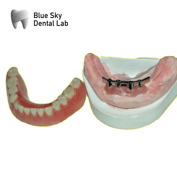 Titanium Dental Locator With Removable Denture And Ball Cap Attachments