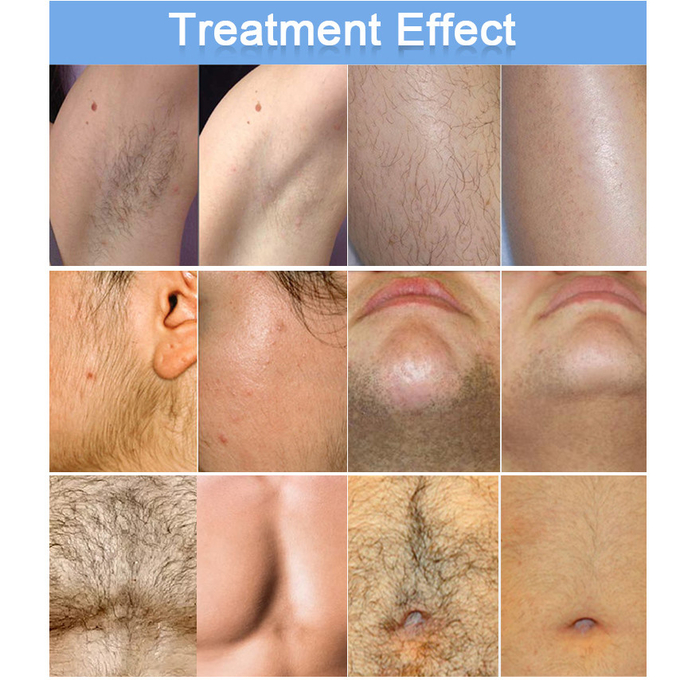 Factory price Portable Permanent Painless 3 Wavelength Diode Laser Hair Removal Machine