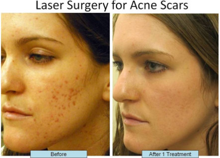 High Energy CO2 Fractional Laser Machine For Skin Scar Removal / Acne Treatment