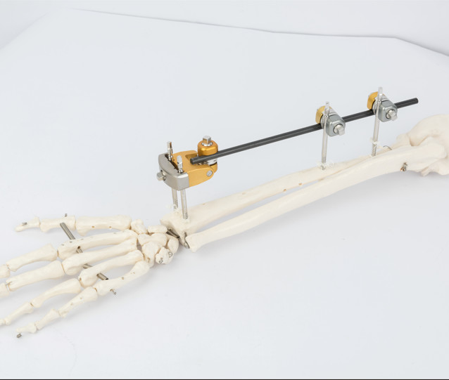 T Shaped Clamp External Fixator For Distal Radius Fracture OEM
