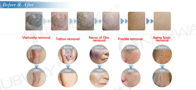 CE approved effective Body Tattoo,Eye line and brow Tattoo removal laser equipment