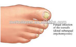 Professional 1064nm Long pulse Nd:YAG Laser nail fungus treatment