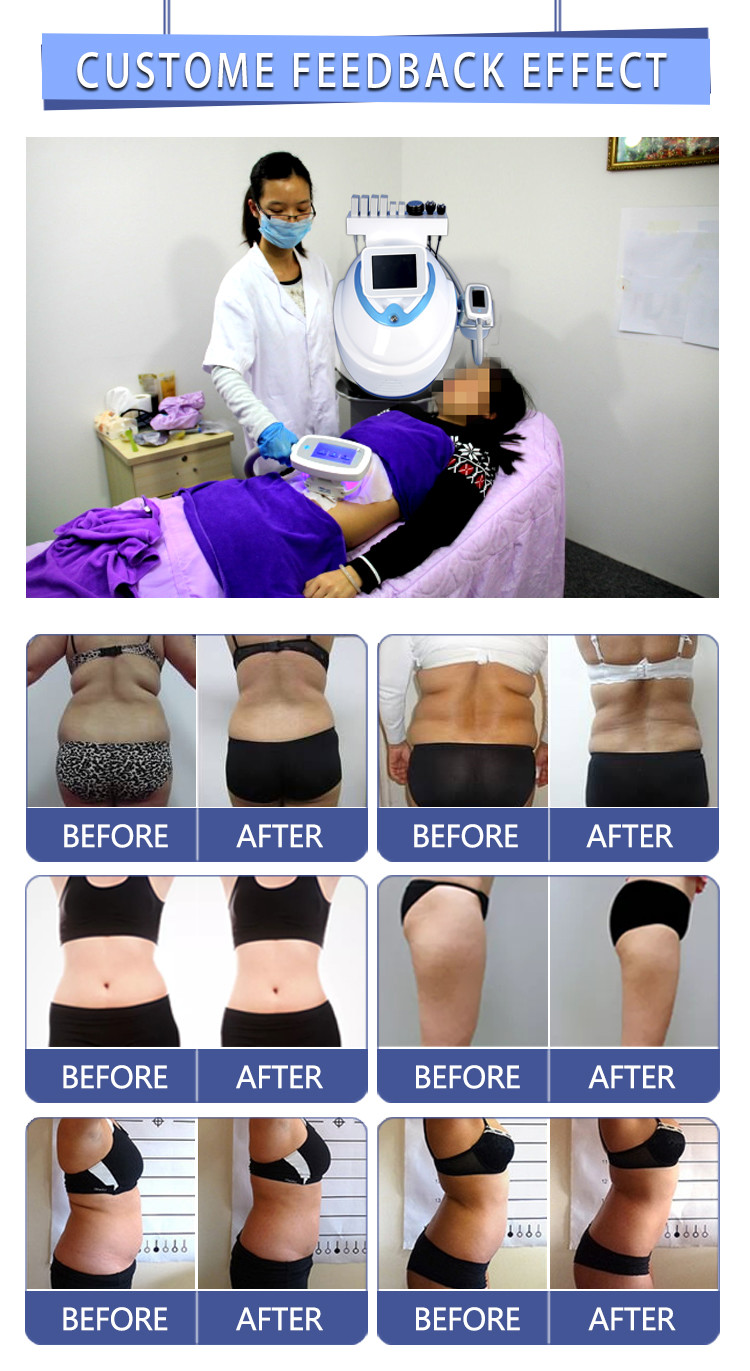 4 in 1 weight loss cavitation rf cryolipolysis lipo laser/criolipolisis fat freezing machine/cryolipolysis slimming mach