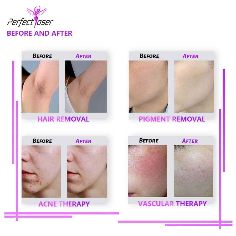 2 Handles IPL Laser Hair Removal Machine 2500W Skin Rejuvenation Beauty Machine