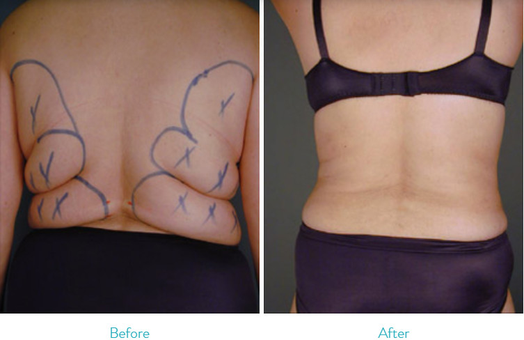 300W Surgical Liposuction Machine for Upper / Lower Back Liposuction