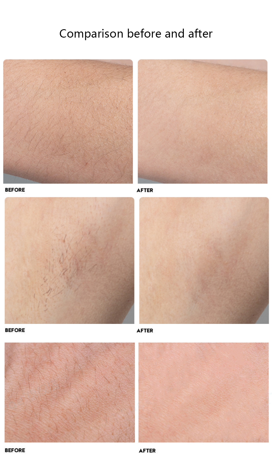 Fiber Diode Painless ipL Hair Removal Equipment New Technology High Energy
