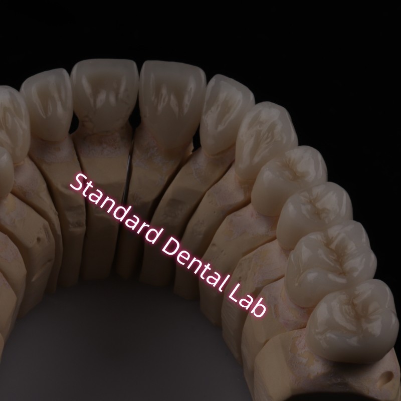 Digital CAD CAM Dental Lab PFZ Crowns Translucent Layered Zirconia Crown