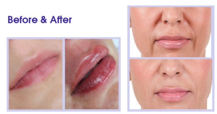 Fosyderm Dermal Filler Hyaluronic Acid Injection 24mg/ml HA For Lips CE