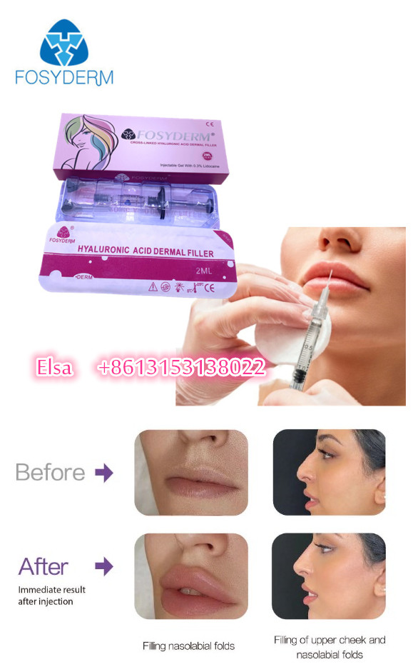 Hyaluronic Acid Fosyderm Dermal Filler For Face Lips Injection 24mg/Ml